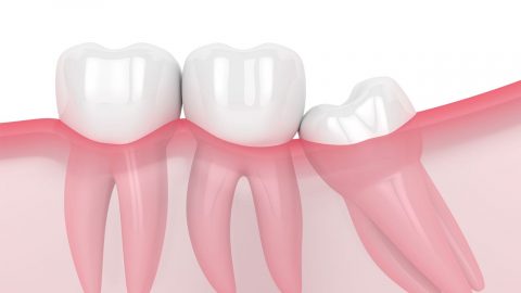 GIẢI ĐÁP: Niềng răng có phải nhổ răng không?