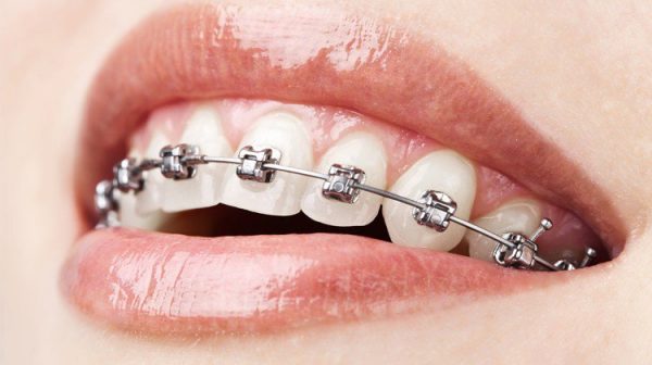 Niềng răng là phương pháp sử dụng các khí cụ trong nha khoa để tác động và đưa răng về đúng vị trí mong muốn trên cung hàm