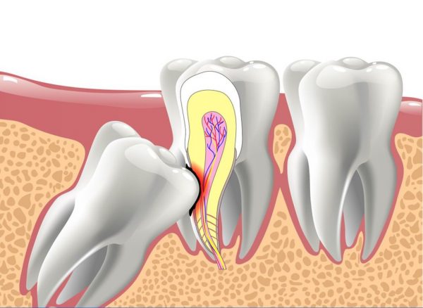 Niềng răng có phải nhổ răng không còn tùy thuộc vào tình trạng cũng như mức độ sai lệch của răng
