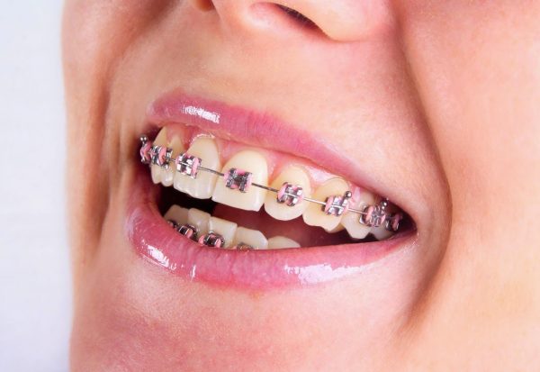 Niềng răng là phương pháp sử dụng khí cụ nha khoa để nắn chỉnh giúp cho răng về đúng vị trí mong muốn trên cung hàm
