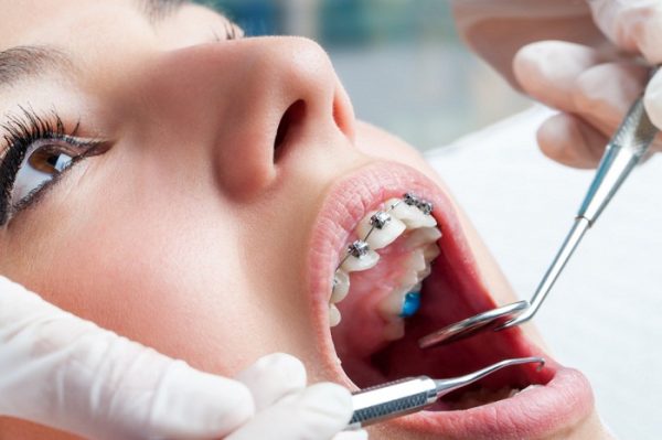 Với thắc mắc niềng răng hô có đau không, có thể niềng răng sẽ đau trong một số giai đoạn cụ thể, ví dụ như đặt chun tách kẽ