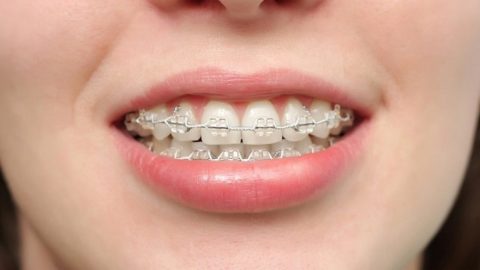 GIẢI ĐÁP: Niềng răng hô có đau không?