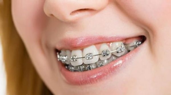 Niềng răng hô mất bao lâu để có hàm răng đều đẹp? 