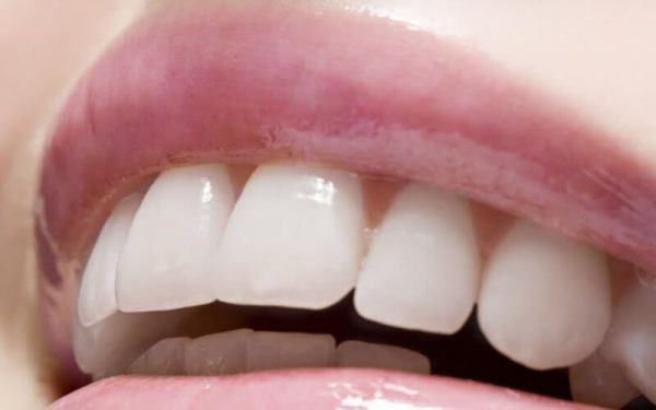 Thời gian niềng răng hô mất bao lâu còn tùy thuộc vào tình trạng răng cụ thể cũng như mức độ hô của răng