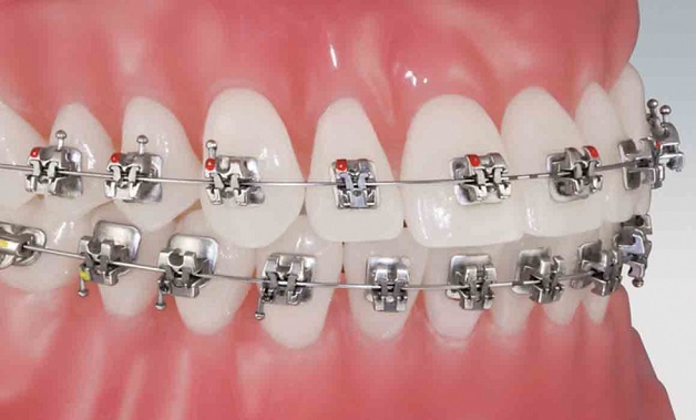 Niềng răng hay còn gọi chỉnh nha là phương pháp sử dụng các khí cụ niềng răng để giúp răng có thể dịch chuyển về đúng vị trí trên cung hàm.