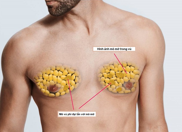 Phì đại tuyến vú ở nam giới nguyên nhân do đâu? | TCI Hospital