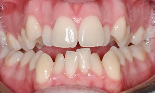 Răng khấp khểnh là một trong những trường hợp có thể điều chỉnh hiệu quả nhờ niềng răng Invisalign