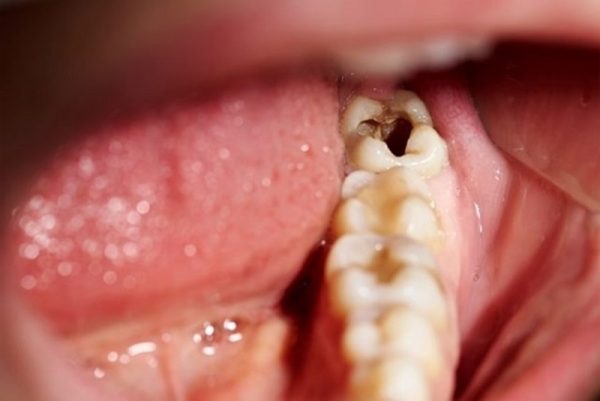 Răng số 8 dễ bị sâu vì nằm ở vị trí khó của cung hàm, khiến cho việc vệ sinh răng cũng trở nên khó khăn hơn tạo điều kiện cho vi khuẩn gây sâu răng dễ dàng xâm nhập và phát triển