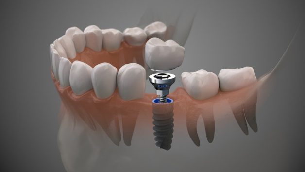 Răng sứ implant
