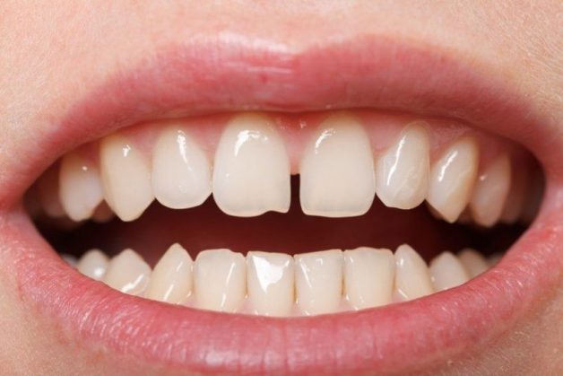 Răng thưa là một trong những trường hợp có thể khắc phục hiệu quả bằng nẹp răng trong suốt