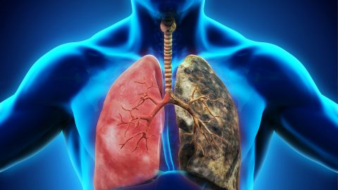 Tiên lượng sống của bệnh nhân ung thư phổi giai đoạn cuối