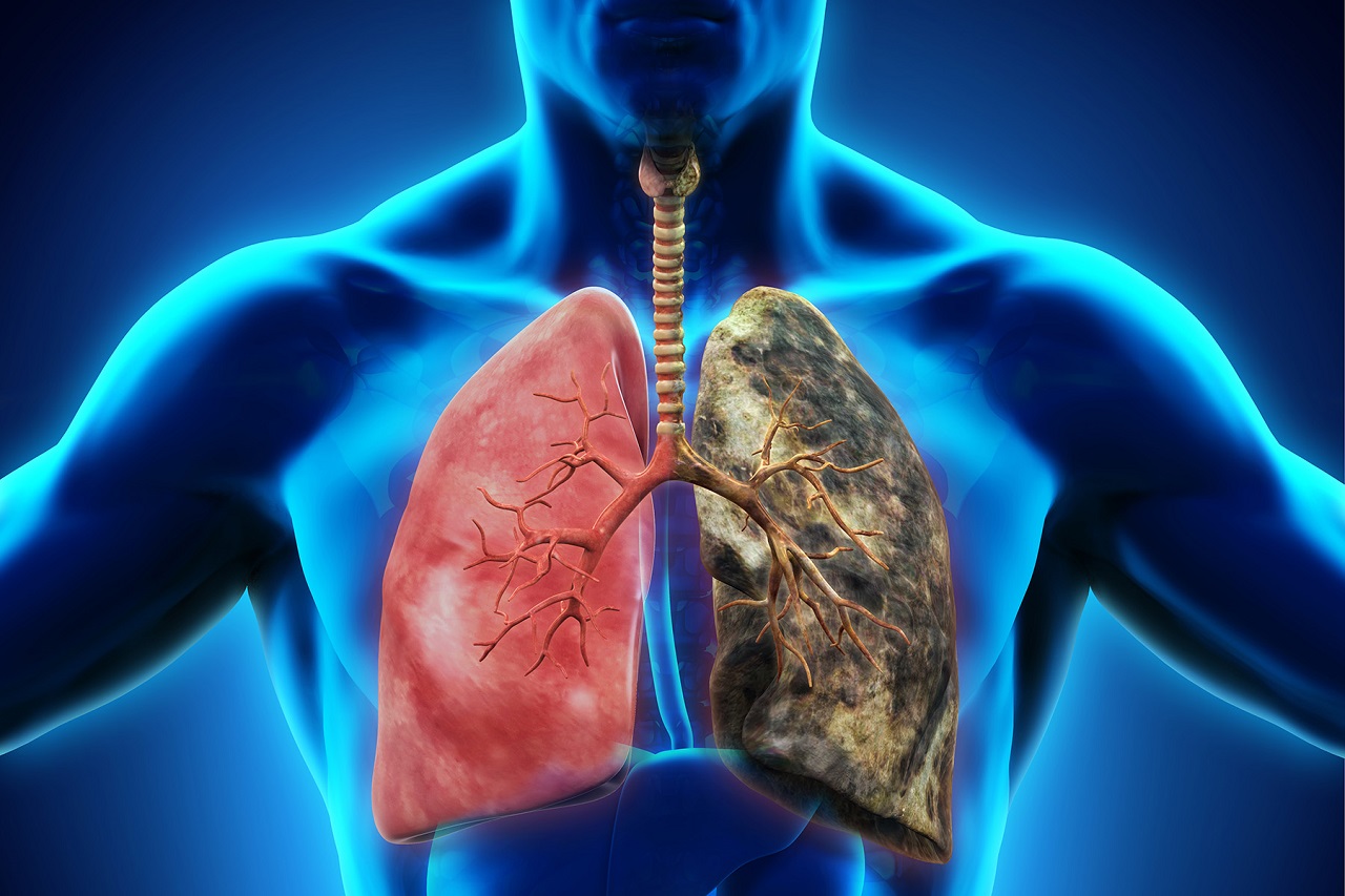 Các biện pháp điều trị ung thư phổi giai đoạn 4 có ảnh hưởng đến sự lây nhiễm không?
