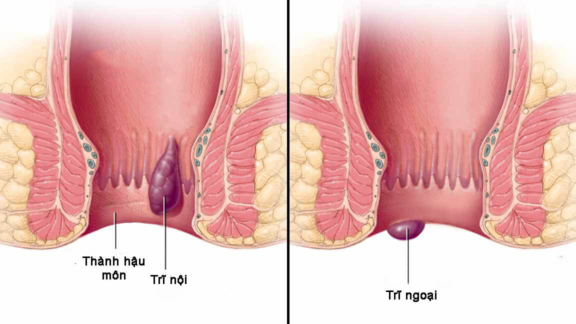 Trĩ nội trĩ ngoại và cách điều trị hiệu quả | TCI Hospital