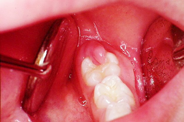 Viêm lợi trùm răng khôn là gì
