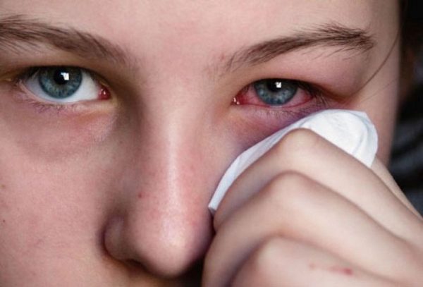 Viêm mũi xoang không được điều trị đúng cách rất dễ xảy ra biến chứng, trong đó có các biến chứng về mắt như: Viêm kết mạc, áp xe tuyến lệ...