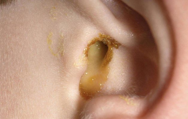 Viêm tai giữa mủ ở trẻ em nếu không được điều trị kịp thời sẽ gây ra những biến chứng nguy hiểm