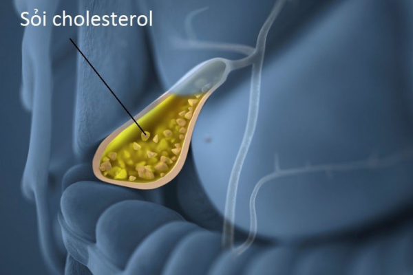 Quá trình tạo sỏi cholesterol túi mật