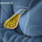 Sỏi cholesterol túi mật được điều trị như thế nào?