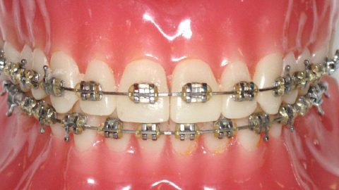 Niềng răng hô có đau không, đau ở giai đoạn nào?