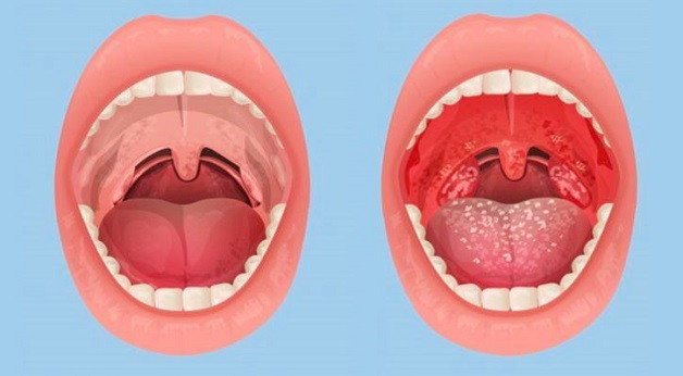 Viêm họng và viêm amidan có thể nói là những bệnh tai mũi họng phổ biến nhất hiện nay