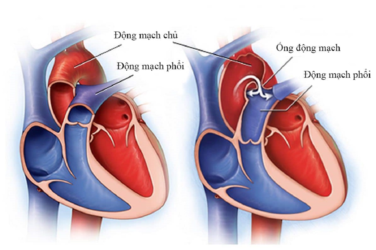 Điều trị hở van tim ở trẻ sơ sinh là gì?
