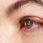 Tại sao bị lẹo ở mắt? Các phương pháp điều trị hiệu quả