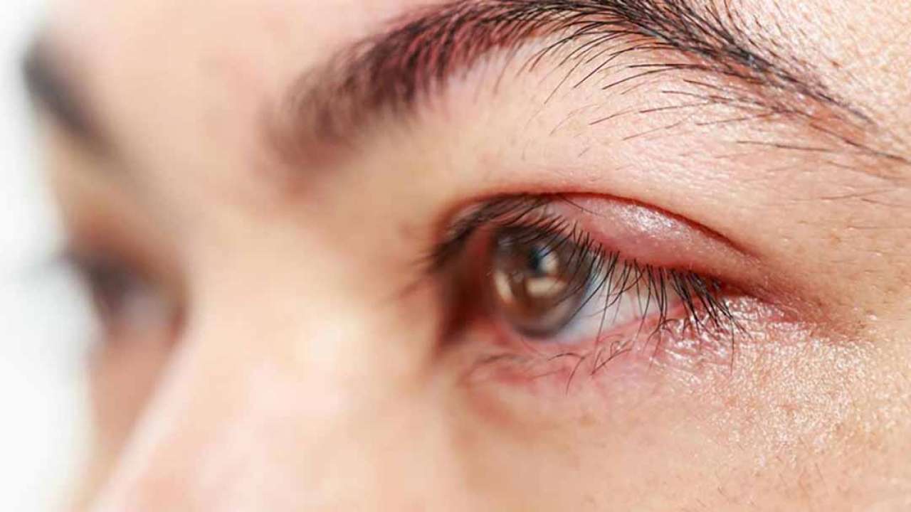Lẹo mắt có gây sưng đỏ vùng mi mắt không?
