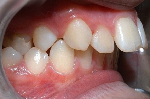 Răng bị hô có nên làm răng sứ không hay bọc sứ có điều trị được hàm hô hay không là thắc mắc của nhiều người