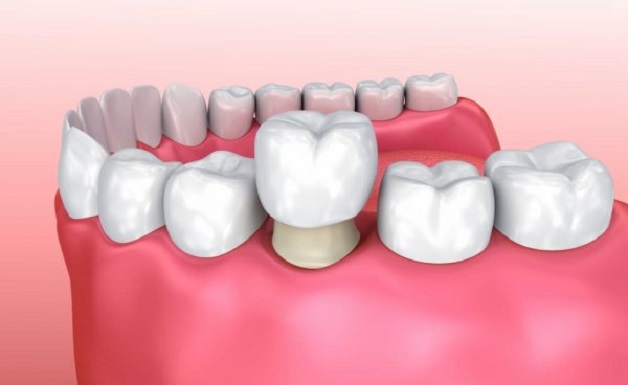 Bọc sứ răng hàm là phương pháp giúp bảo tồn được răng thật và được sử dụng phổ biến hiện nay