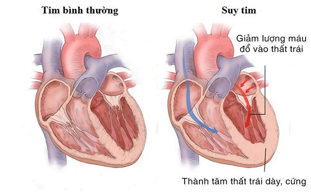 các bệnh lý tim mạch nào gây khó thở?