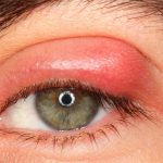 Nguyên nhân, triệu chứng và cách điều trị chắp lẹo mắt