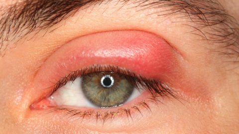 Nguyên nhân, triệu chứng và cách điều trị chắp lẹo mắt