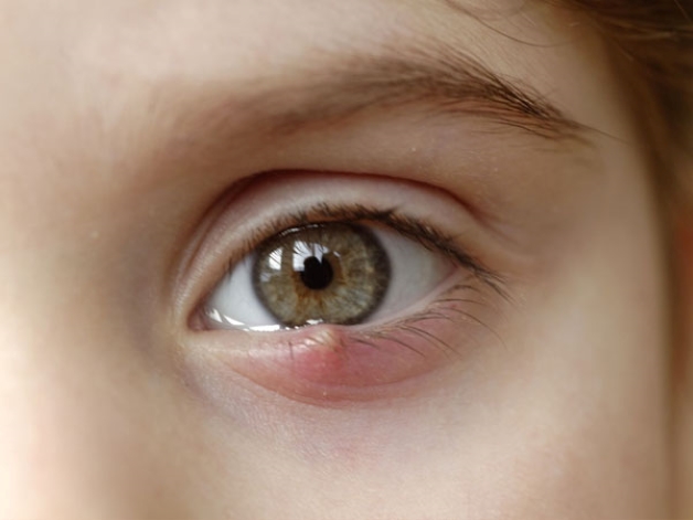 Chắp xuất hiện với một dạng khối u ở mi mắt, tuy nhiên khối u này lại không gây ra cảm giác đau nhức cho người bệnh