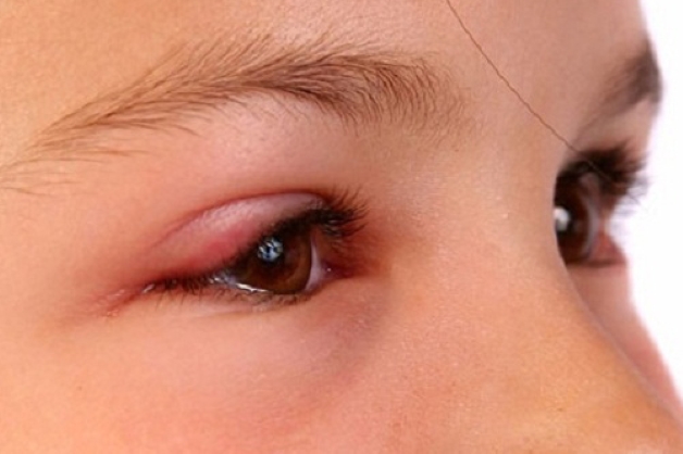 Khi bị lẹo, người bệnh ban đầu sẽ có cảm giác mi mắt bị ửng đỏ đi kèm với cảm giác hơi ngứa và đau nhức