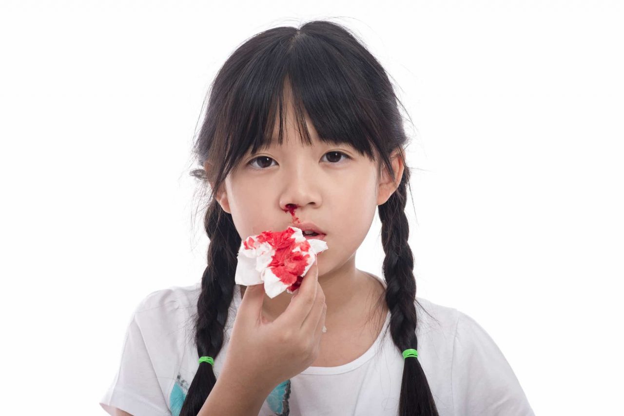 Làm thế nào để ngăn ngừa chảy máu mũi?
