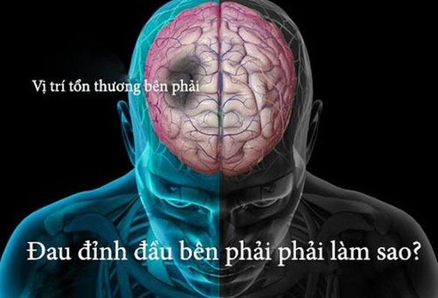 7. Đau đỉnh đầu do lạm dụng thuốc