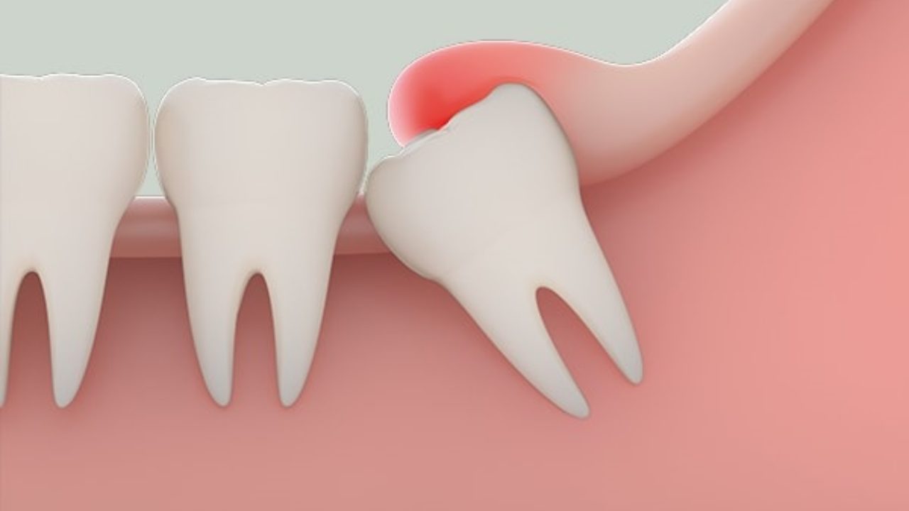 Răng khôn số 48 thuộc vị trí nào trong cung hàm của bạn?
