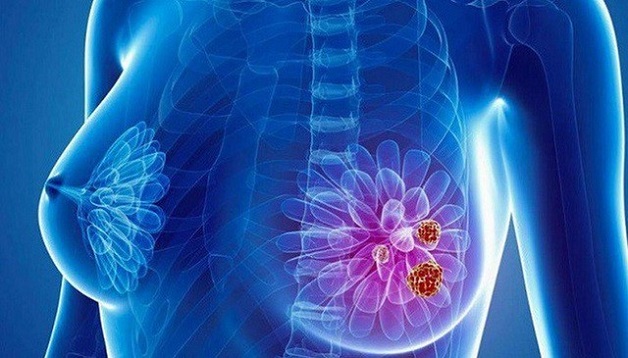 phát hiện sớm ung thư vú như thế nào