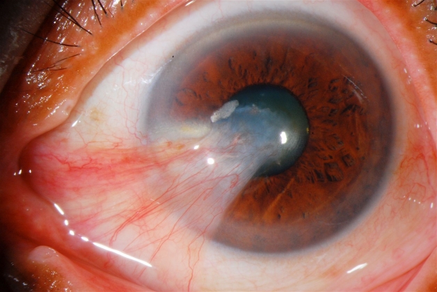 Triêu chứng thường xuất hiện đó là có một khối trắng phát triển cùng với các mạch máu, khối trắng này dễ dàng nhận thấy được ở vị trí góc trong hoặc góc ngoài của mắt