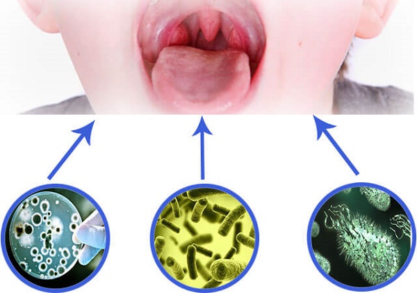 Virus, vi khuẩn là nhóm nguyên nhân hàng đầu gây nên bệnh lý viêm mũi họng cấp