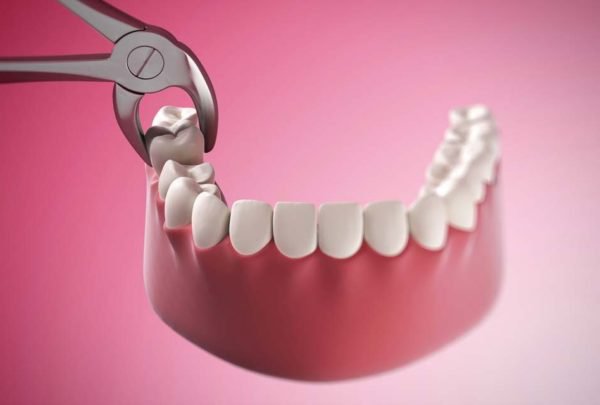 Nhổ răng hàm là chỉ định cần thiết cho trường hợp răng mọc lệch, răng mọc ngầm hoặc răng sâu nặng