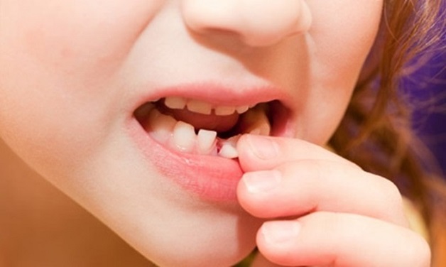 Phụ huynh lưu ý cần nhổ răng sữa cho trẻ đúng thời điểm