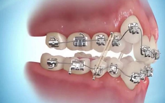 Niềng răng trở thành giải pháp tối ưu cho những trường hợp răng khấp khểnh