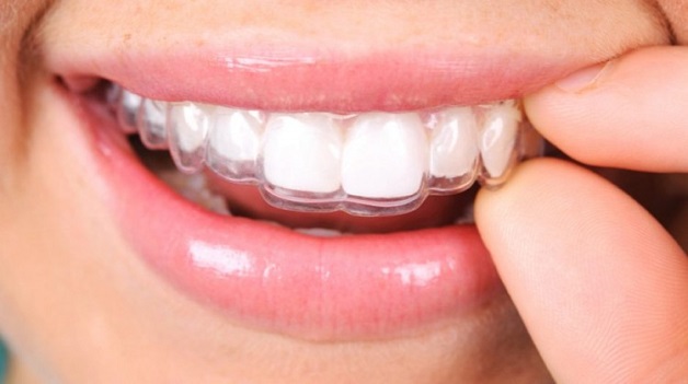 Niềng răng không mắc cài là phương pháp sử dụng khay niềng được thiết kế dựa trên cấu trúc và hình dạng của răng