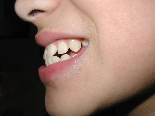 Ở những trường hợp răng hô, móm, hoặc lệch lạc nặng thì bắt buộc phải nhổ răng 