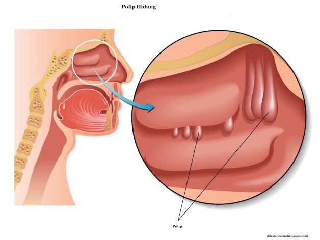 Polyp xoang hàm là một trong những dạng tăng sinh niêm mạc dưới vùng xoang hàm tạo nên những khối có cuống hoặc không có cuống trông giống khối u nhưng hoàn toàn lành tính.