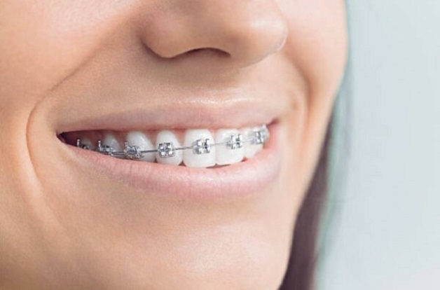 Quá trình niềng răng móm trung bình thường kéo dài trong khoảng từ 1 đến 3 năm tùy vào tình trạng cụ thể