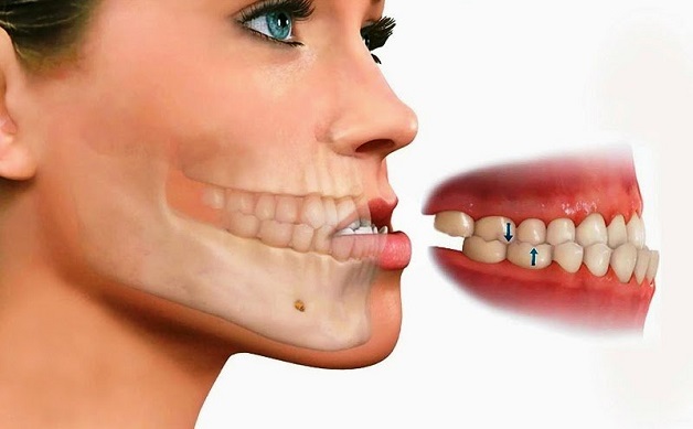 Răng móm là một dạng sai lệch khớp cắn do khớp cắn bị ngược, vòm hàm dưới nhô ra so với hàm trên