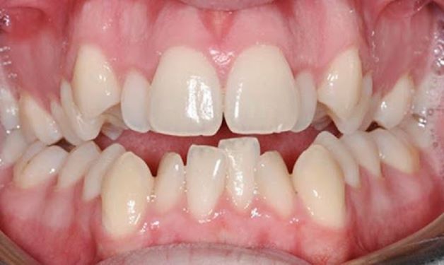 Răng mọc lệch là tình trạng răng mọc không đúng vị trí, răng bị chen chúc, xô lệch dẫn đến khớp cắn hai hàm không khớp nhau.