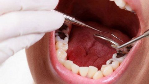 Răng số 8 bị sâu vỡ: Nguyên nhân và giải pháp khắc phục